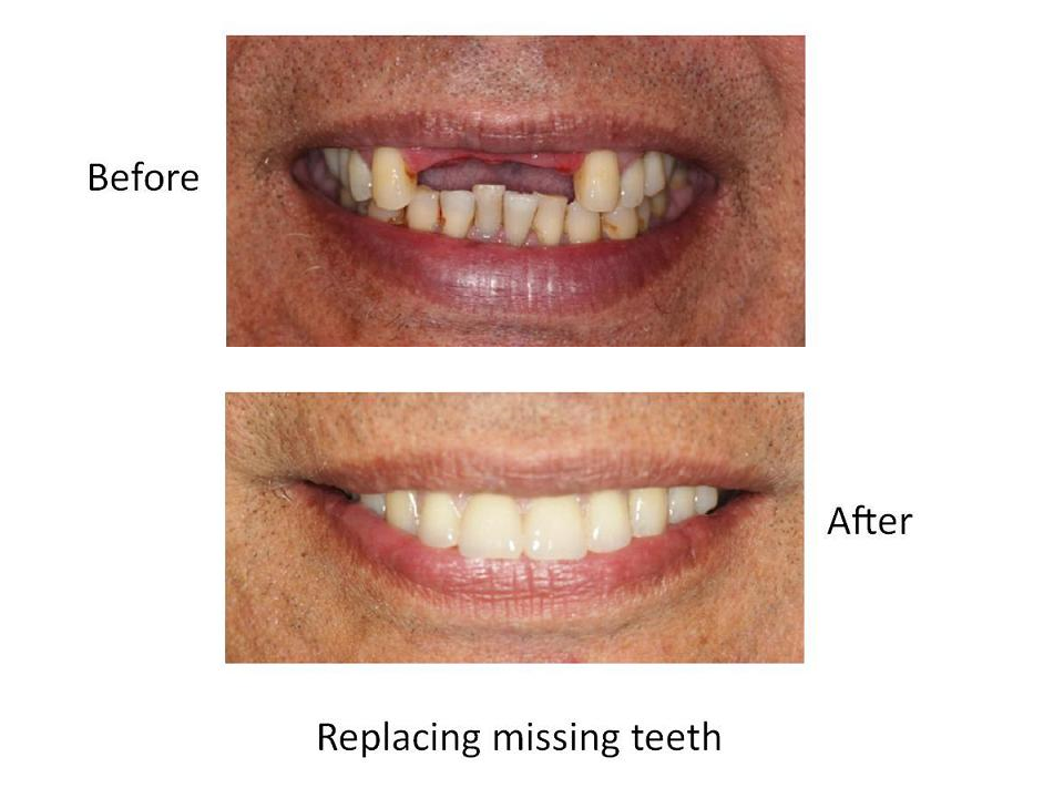Replacing missing teeth