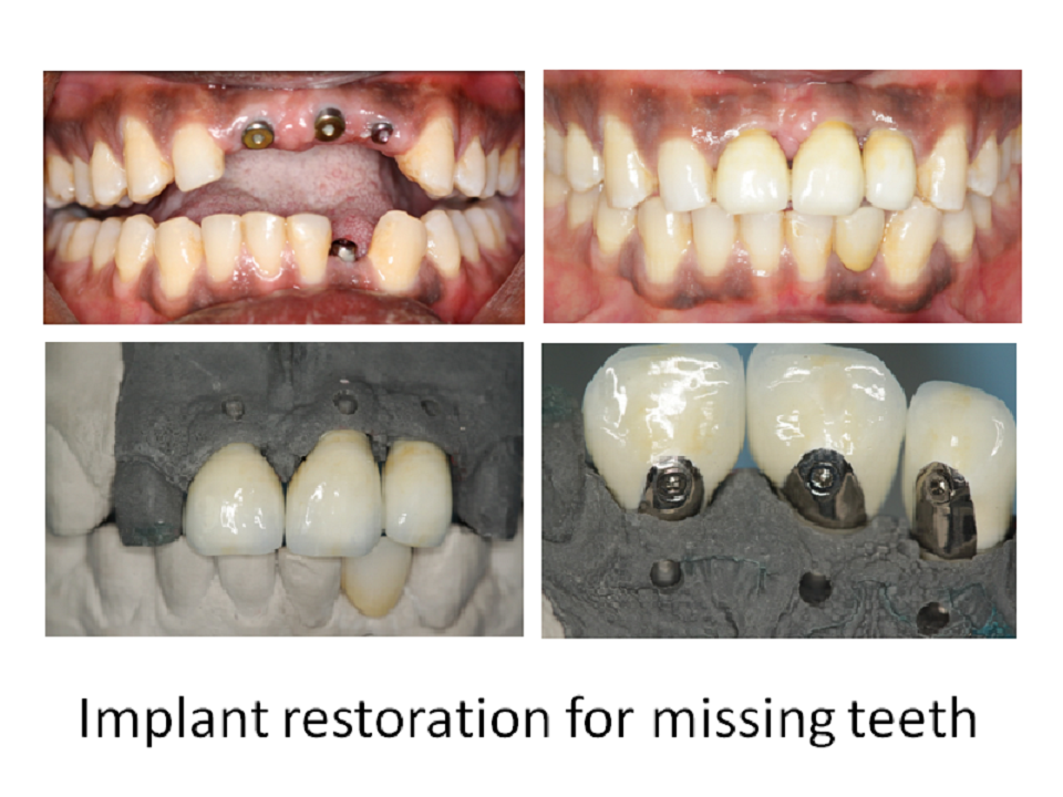 Implant restoration for missing teeth