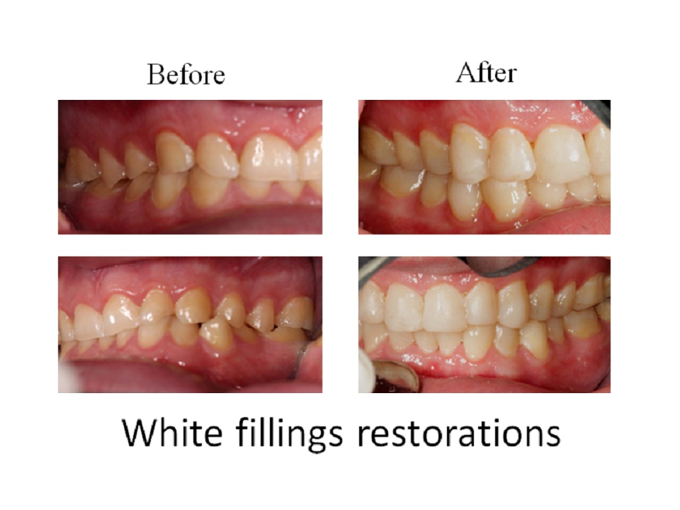 White fillings restorations