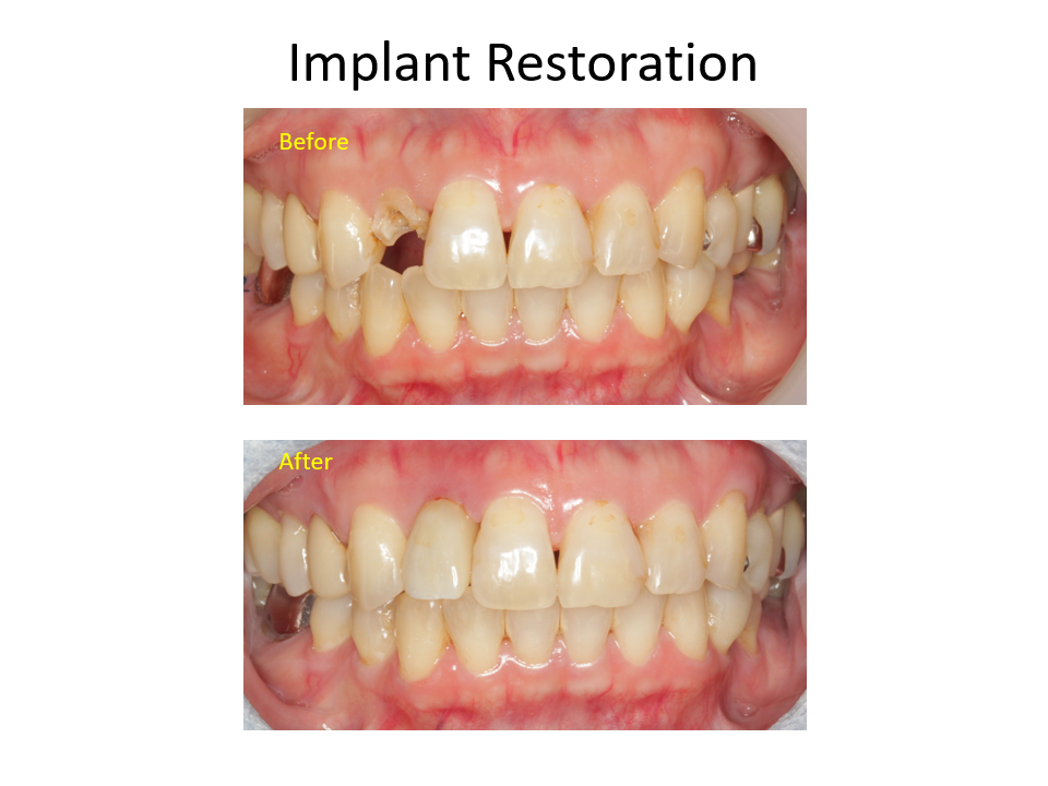 Implant Restoration